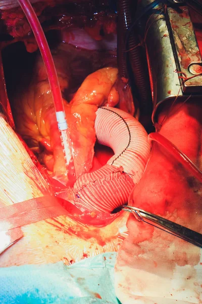 El proceso de cirugía cardíaca. La cirugía del corazón . — Foto de Stock