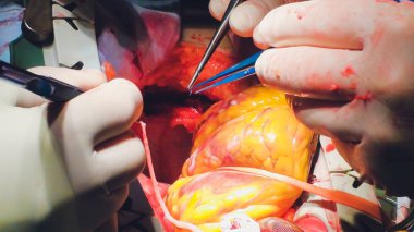 Kalp cerrahisi işlemidir. Kalp ameliyatı.