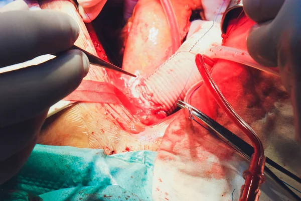 Processen för hjärtkirurgi. Hjärtkirurgi. — Stockfoto