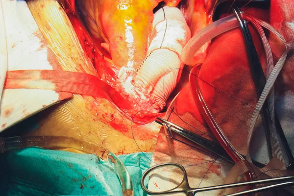 Η διαδικασία της καρδιοχειρουργικής. Η χειρουργική επέμβαση καρδιών. — Φωτογραφία Αρχείου