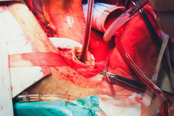 Le processus de chirurgie cardiaque. La chirurgie cardiaque . — Photo