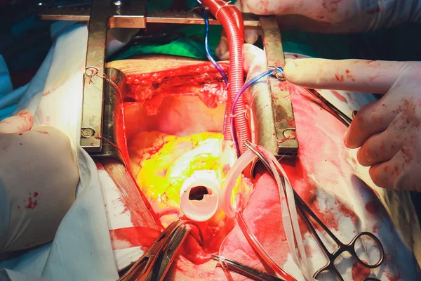 The process of cardiac surgery. The heart surgery