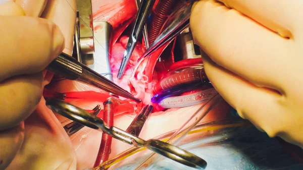 O processo de cirurgia cardíaca. A cirurgia cardíaca . — Fotografia de Stock