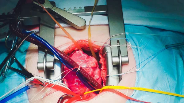 The process of cardiac surgery. The heart surgery. — Stock Photo, Image