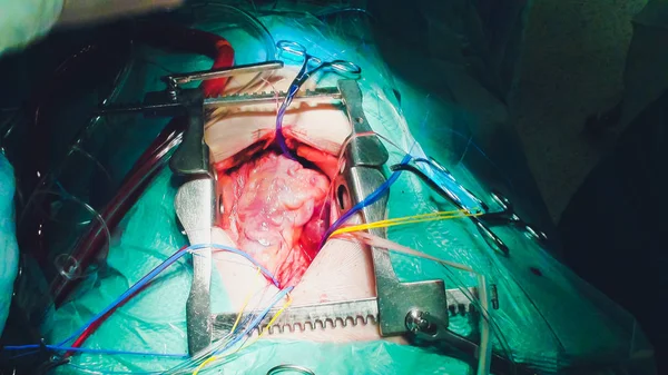 心臓手術のプロセスです。心臓手術. — ストック写真
