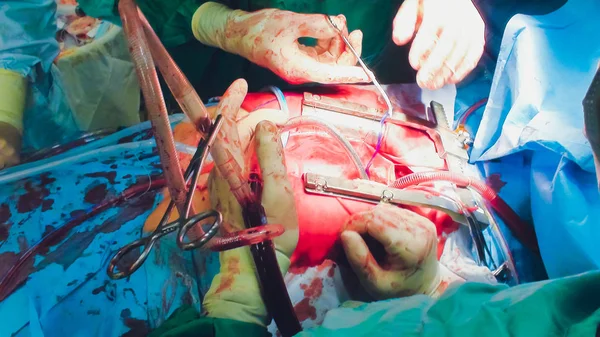 El proceso de cirugía cardíaca. La cirugía del corazón . — Foto de Stock