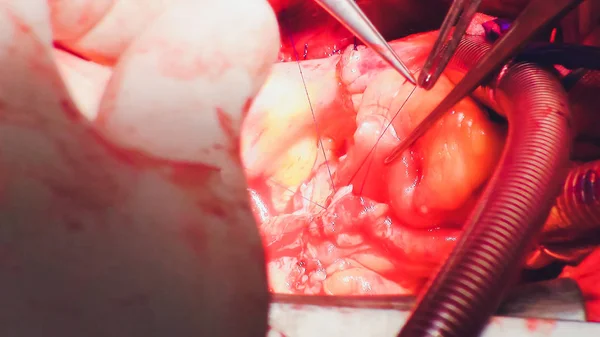 El proceso de cirugía cardíaca. La cirugía del corazón . — Foto de Stock