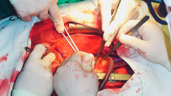 El proceso de cirugía cardíaca. La cirugía del corazón . —  Fotos de Stock