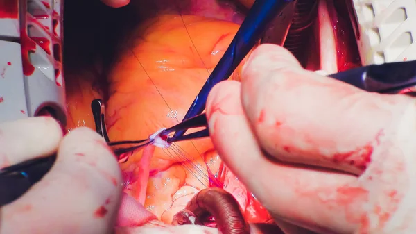 El proceso de cirugía cardíaca. La cirugía del corazón . —  Fotos de Stock