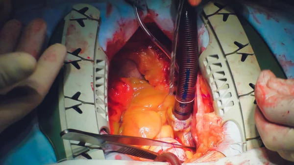 The process of cardiac surgery. The heart surgery. — Stock Photo, Image
