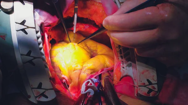 The process of cardiac surgery. The heart surgery. — Stock Photo, Image
