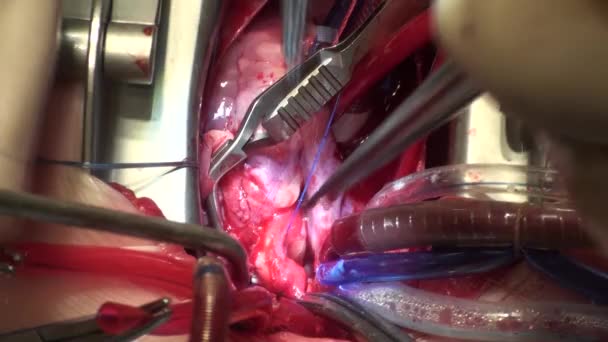 El proceso de cirugía cardíaca. La cirugía del corazón . — Vídeos de Stock