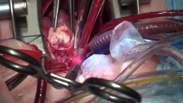 Il processo di chirurgia cardiaca. La chirurgia cardiaca . — Video Stock