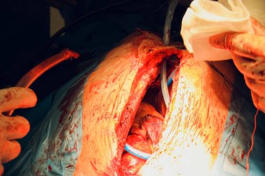 Doktor kalp operasyonu kalp nakli işlemi yapıyor