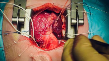 Doktor kalp operasyonu kalp nakli işlemi yapıyor