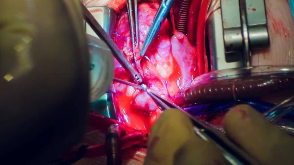 Doctor doing heart operation heart transplant operation