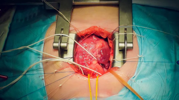 做心脏手术心脏移植手术的医生 — 图库照片