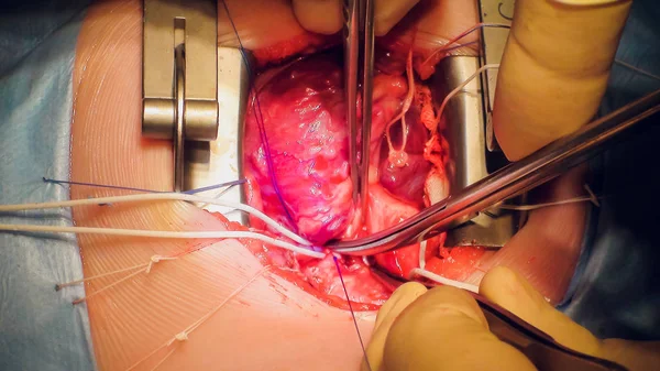 Doktor kalp operasyonu kalp nakli işlemi yapıyor — Stok fotoğraf
