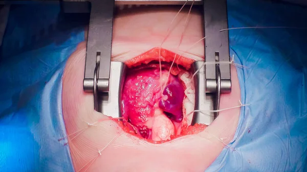 Ezzel a szív működését Szív transzplantáció művelet orvos — Stock Fotó