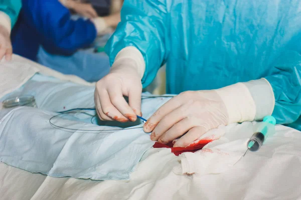 Equipo médico de cirujanos en el hospital realizando intervenciones quirúrgicas mínimamente invasivas. Sala de cirugía con equipo de electrocauterio para centro de cirugía de emergencia cardiovascular . — Foto de Stock