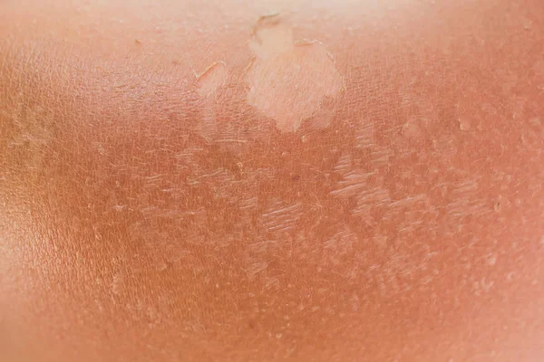 Burnt skin macro, skin slides hand tears off. — Stock Photo, Image