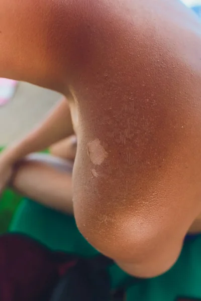 Burnt skin macro, skin slides hand tears off. — Stock Photo, Image