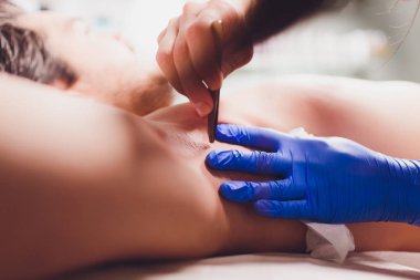 Cımbız epilasyon erkek, kozmetoloji, shugaring sonra koltuk altı saç çıkarma.