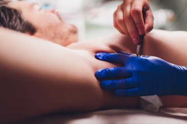 Cımbız epilasyon erkek, kozmetoloji, shugaring sonra koltuk altı saç çıkarma.