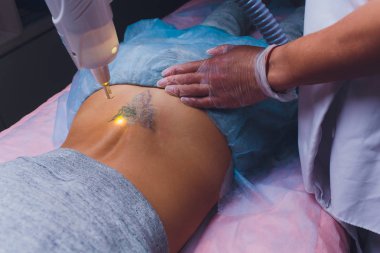 Kuaförde hasta ve profesyonel dövme silme lazeri olan bir kozmetolog..