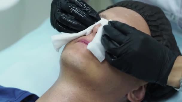 男性の美容学。美容クリニックで顔の手術を受けている若い男性。剥離皮膚. — ストック動画