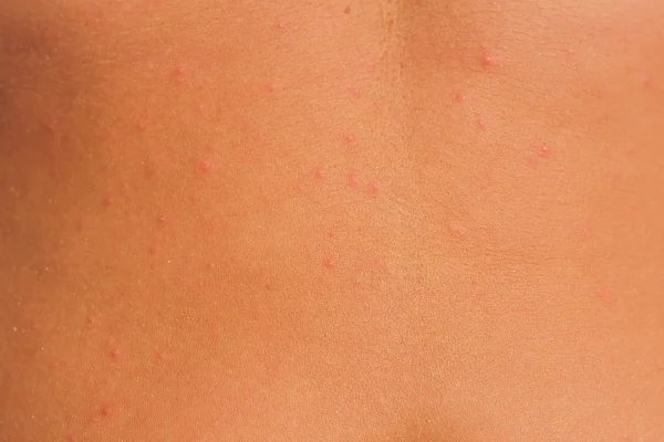 Acne on the back of a woman,Acne on the back,skin of a woman is acne. — Stock Photo, Image