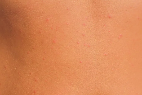 Acne on the back of a woman,Acne on the back,skin of a woman is acne. — Stock Photo, Image