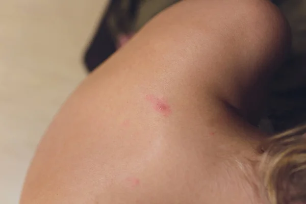 健康过敏皮肤护理问题。特写 年轻女子 抓痒背部过敏皮疹. — 图库照片