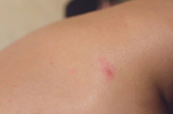 Egészségügyi allergia bőrápolási probléma. Closeup fiatal nő vakarja őt viszkető vissza allergia kiütés. — Stock Fotó