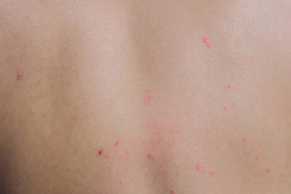 Проблемы с аллергией на кожу. Молодая женщина крупным планом чешет спину аллергической сыпью . — стоковое фото