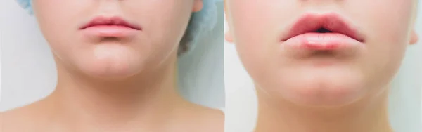 Powiększanie ust. Piękne młode womans usta odbieranie kwas hialuronowy wstrzykiwań. Zbliżenie z kosmetyczki ręce robi piękno procedury sexy female usta. Leczenie kosmetologii. Wysoka rozdzielczość. — Zdjęcie stockowe