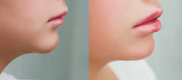 Збільшення губ. Прекрасний рот молодих жінок, що отримує гіалуронову кислоту. Крупним планом косметолог руки роблять процедуру краси для сексуальних жіночих губ. Косметологічне лікування. Висока роздільна здатність . — стокове фото
