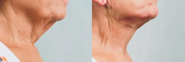 Mujer anciana haciendo mesothreads y Thread Lifting, Cosmetología. Procedimiento cosmético para eliminar los signos de envejecimiento. Belleza facial, contorno facial, concepto de cirugía plástica para la edad de 70-80 años . —  Fotos de Stock