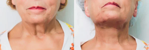 Aged woman doing mesothreads and Thread Lifting, Cosmetology. Cosmetic procedure to eliminate signs of aging. Beauty Face, Facial contour, plastic surgery concept for Age 70-80 years.