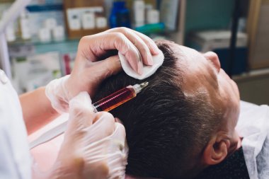 Güzellik enjeksiyonları ile kellik tedavisi. Eldivenli kozmetolojist elleri deri altı enjeksiyonuyguluyor. Plasmalifting erkek hasta.