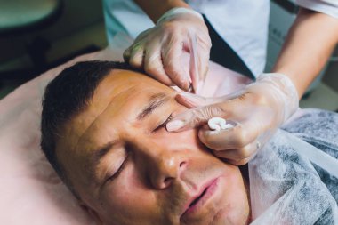 Yüz germe işleminin yakın çekimPdo Dikiş ameliyatı, yüz germe ameliyatı. Yeni iplik kaldırma yenilikçi tekniği, Novathreads ve Siluet Instalift erkek çanta göz altında.