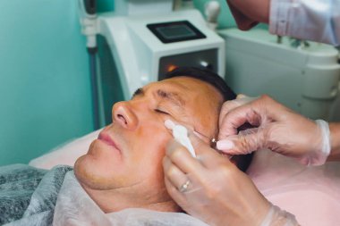 Yüz germe işleminin yakın çekimPdo Dikiş ameliyatı, yüz germe ameliyatı. Yeni iplik kaldırma yenilikçi tekniği, Novathreads ve Siluet Instalift erkek çanta göz altında.