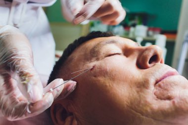 Yüz germe işleminin yakın çekimPdo Dikiş ameliyatı, yüz germe ameliyatı. Yeni iplik kaldırma yenilikçi tekniği, Novathreads ve Siluet Instalift erkek çanta göz altında.