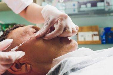 Yüz germe işleminin yakın çekimPdo Dikiş ameliyatı, yüz germe ameliyatı. Yeni iplik kaldırma yenilikçi tekniği, Novathreads ve Siluet Instalift erkek çanta göz altında.