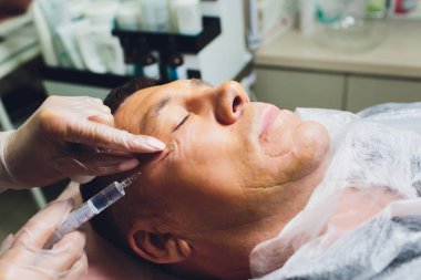 Yüz germe işleminin yakın çekimPdo Dikiş ameliyatı, yüz germe ameliyatı. Yeni iplik kaldırma yenilikçi tekniği, Novathreads ve Siluet Instalift erkek çanta göz altında.