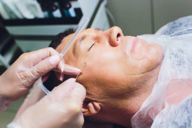 Yüz germe işleminin yakın çekimPdo Dikiş ameliyatı, yüz germe ameliyatı. Yeni iplik kaldırma yenilikçi tekniği, Novathreads ve Siluet Instalift erkek çanta göz altında.