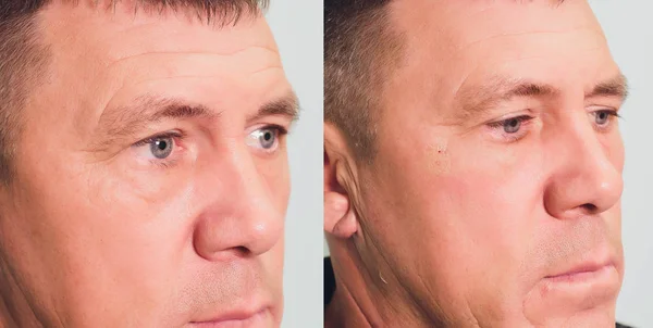 Zbliżenie procedury do podnoszenia twarzy operacja Suture PDO, zabieg podnoszenia twarzy. Innowacyjna technika nowy wyciąg wątku, Novathreads i Silhouette Instalift męskie torby pod oczami. — Zdjęcie stockowe