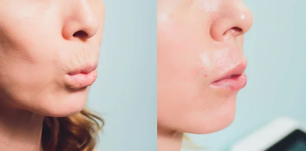 Close-up de umas mãos enfiando belas mulheres lábio superior . — Fotografia de Stock