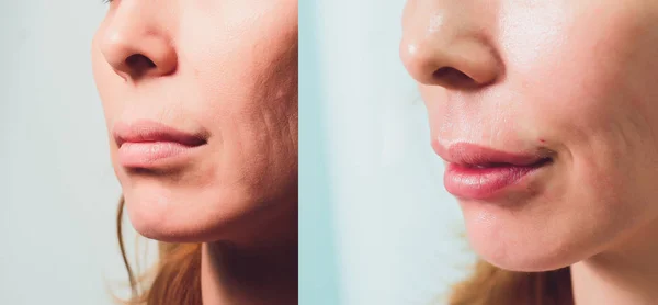 Close-up de umas mãos enfiando belas mulheres lábio superior . — Fotografia de Stock