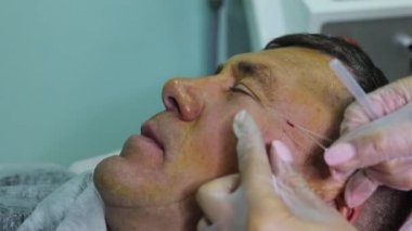 Güzellik enjeksiyonları ile kellik tedavisi. Eldivenli kozmetolojist elleri deri altı enjeksiyonuyguluyor. Plasmalifting erkek hasta.